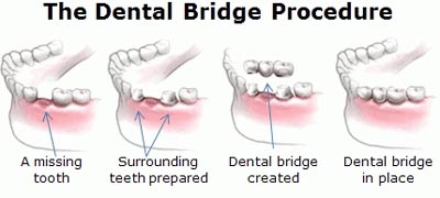 dental bridge teeth repair missing gap gaps bridges fix crack restoration tooth procedure center benefits able