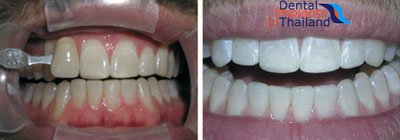 teeth-whitening-thailand-prices-before-after-pictures