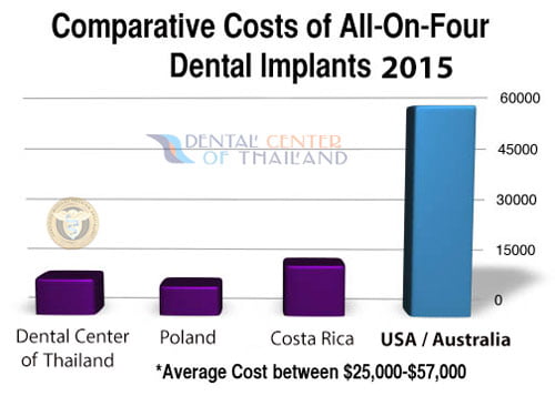What is the average price for dental veneers?