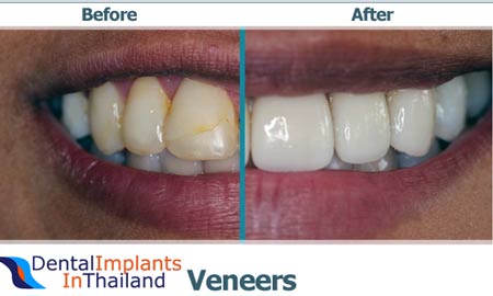 dental-porcelain-vaneers-thailand-bangkok