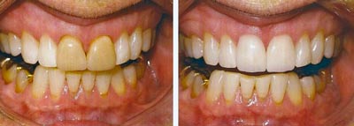 dental-vaneers-bangkok-before-after-pictures