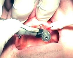 mini-dental-implants-Phuket-thailand