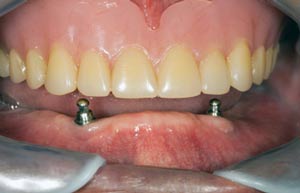 mini-implants-dental-thailand-prices-reviews