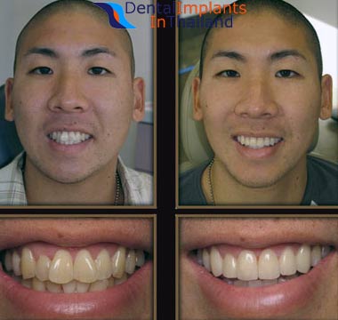 Get Pure White Porcelain Veneers in Thailand