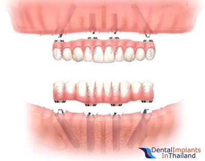 all-on-4-dental-implants-phuket-thailand-xray-before-after