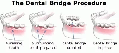 dental-bridge-bangkok-gap-teeth-repair
