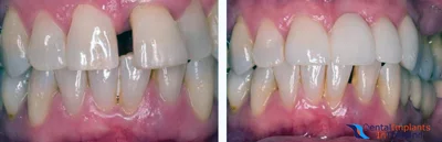 dental-bridge-thailand-before-after-pictures