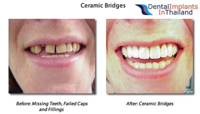 dental-bridges-bangkok-thailand-before-after-pictures