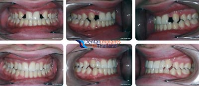 dental-bridges-bangkok-thailand-before-after-pictures