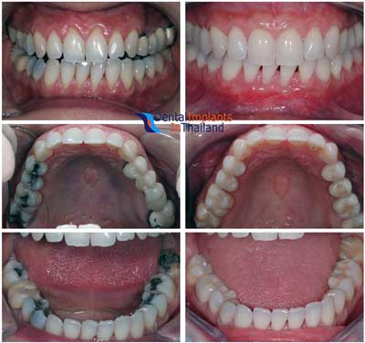 Composite White Fillings High Quality Resin Fillers for Less