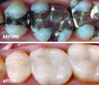 dental-composite-fillers-bangkok-resin-before-after