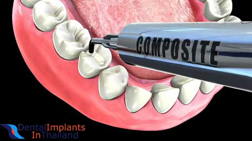 Composite White Fillings High Quality Resin Fillers for Less