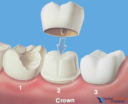 Affordable and Durable Porcelain Crowns for Less