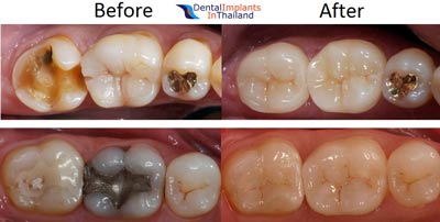 dental-crowns-alloy-ceramic-porcelain-bangkok-reviews-before-after-pictures