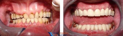 dental-crowns-thailand-before-after-pictures