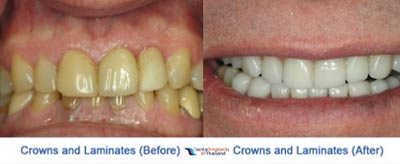 dental-crowns-thailand-vaneers-before-after