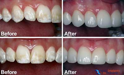 composite filling cost