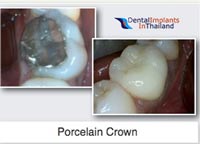 porcelain-crowns-ceramic-bangkok-reviews-before-after-pictures