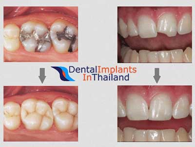 resin-white-composite-fillers-bangkok-before-after
