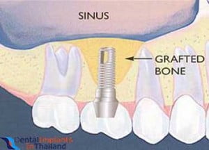 sinus-lift-thailand-surgery