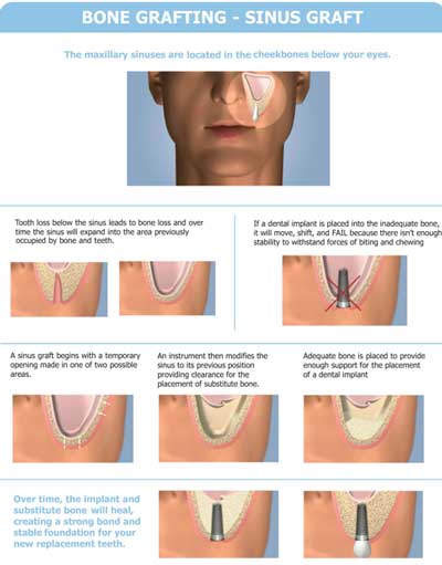 surgical-sinus-lift-treatment-thailand-before-after-pictures