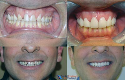 dental-smile-makeover-thailand-before-after-pictures
