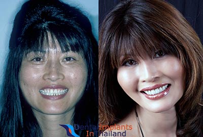 smile-makeover-bangkok-thailand-phuket-before-after-pictures