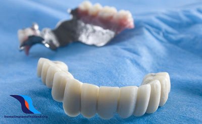 Denture-Stabilization-Implants-Costs-prices-reviews-thailand