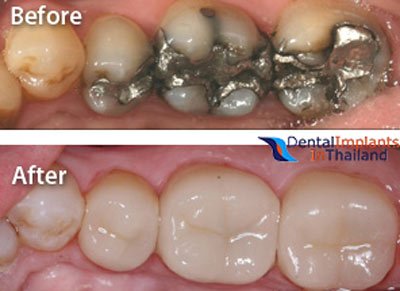 color-restorations-dental-bangkok-thailand-before-after
