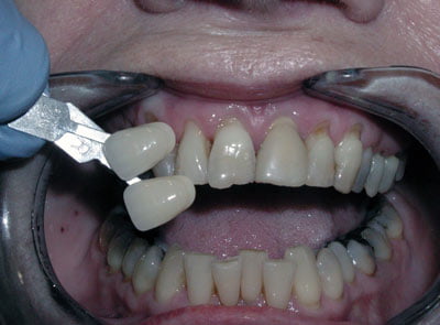 full-dental-restorations-implants-bangkok-thailand-before-after