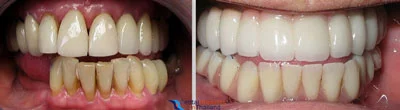 implant-retained-dentures-thailand