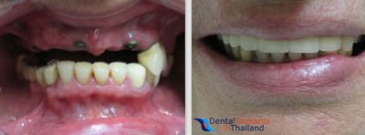 implant-supported-dentures-thailand