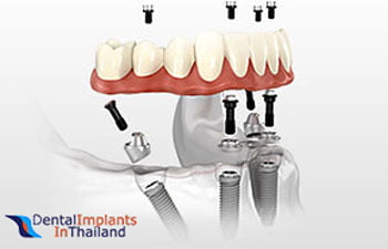 permanent-partial-dentures-system-thailand
