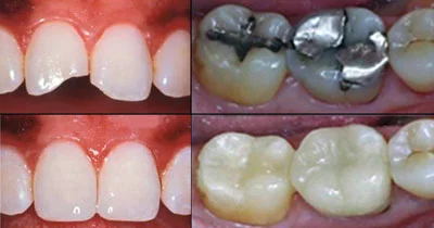 tooth-color-fillings-natural-composite-before-after-thailand