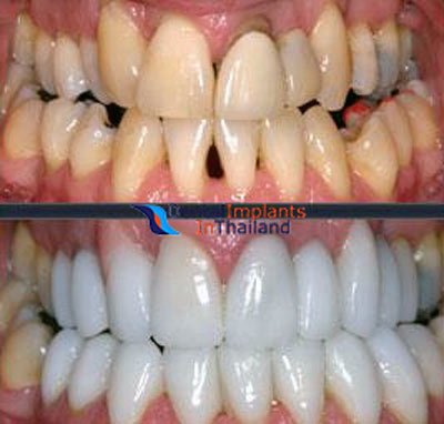 tooth-color-restoration-thailand