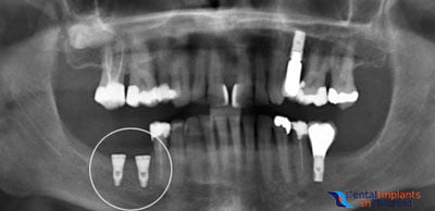 before-after-xray-zygomatic-dental-implants-bangkok-prices