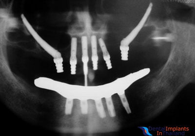 before-after-xray-zygomatic-dental-implants-thailand-prices