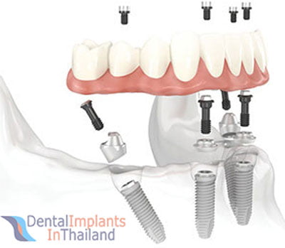 before-after-zygomatic-dental-implants-thailand-prices
