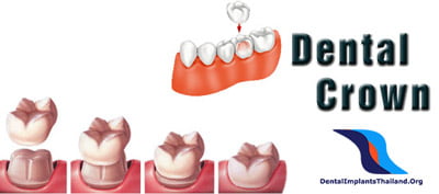 dental-crowns-bangkok-thailand-prices