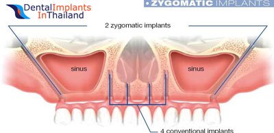 zygomatic-dental-implants-thailand-prices