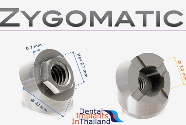 Affordable Zygomatic Implants Graftless Procedure