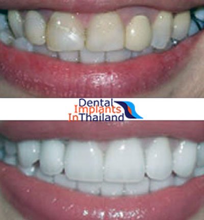 teeth-whitening-bangkok-before-after-pictures