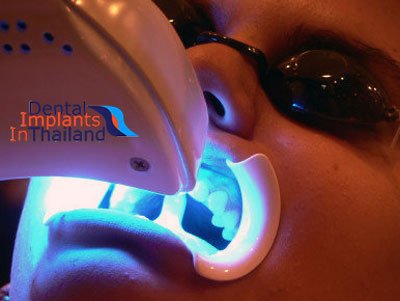 zoom-2-laser-teeth-whitening-thailand-prices-before-after-pictures