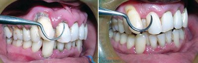 gingivitis-gum-disease-before-after-treatment-thailand