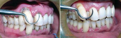 gingivitis before and after treatment