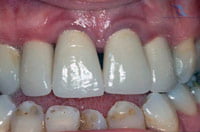 gingivitis-treatment-bangkok