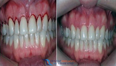 gum-disease-gingivitis-before-after-treatment-thailand