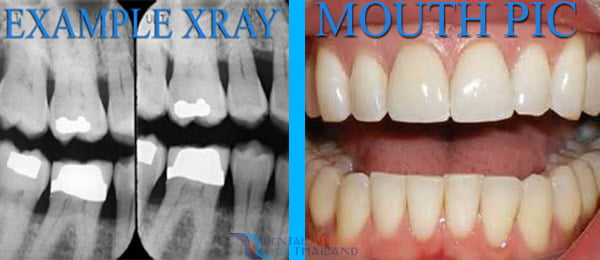 Dental Xray Example