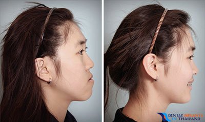 Jaw Surgery for Overbite