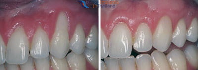 before-after-gum-grafting-bangkok